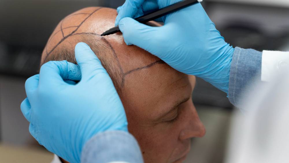Scalp Micropigmentation