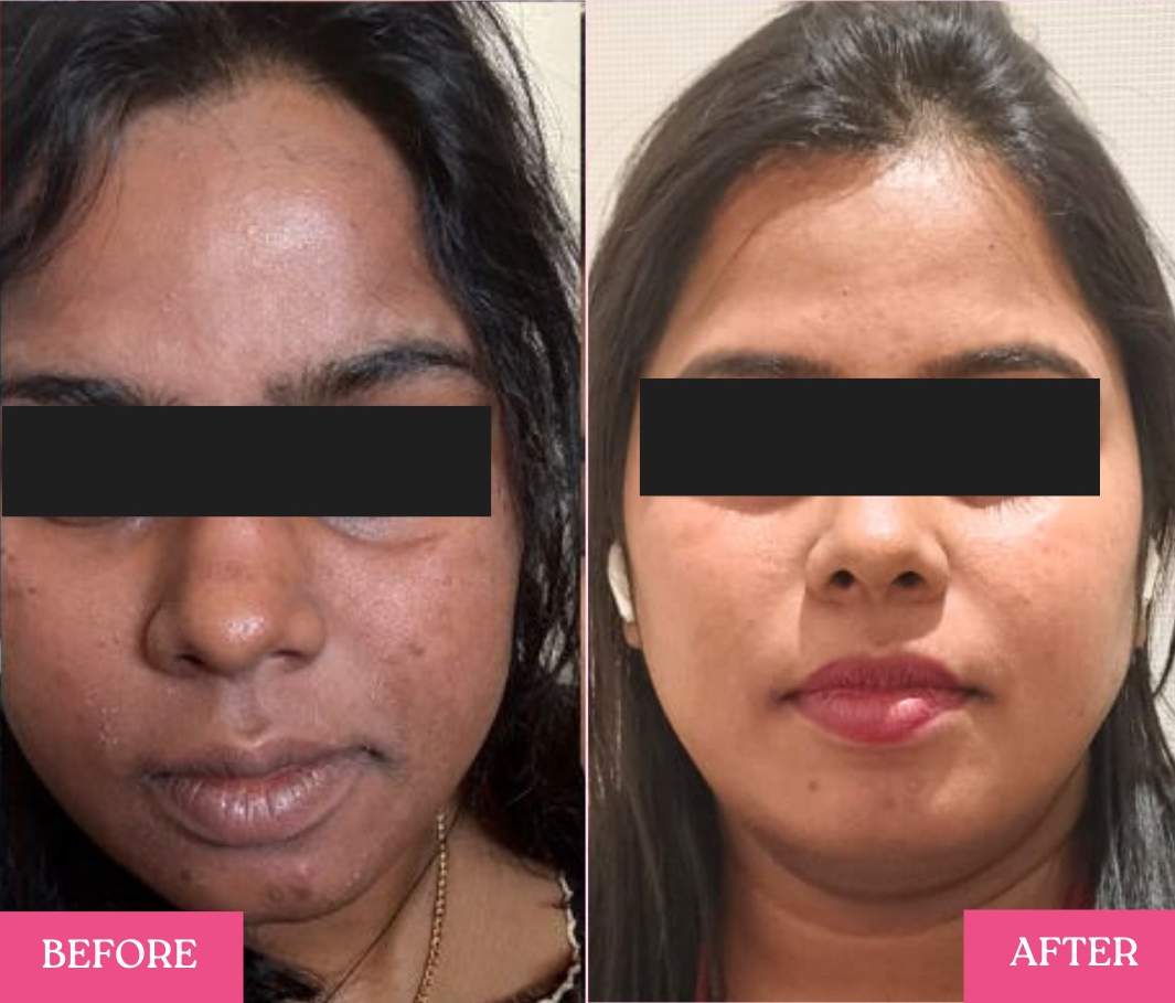 Laser Skin Brightening