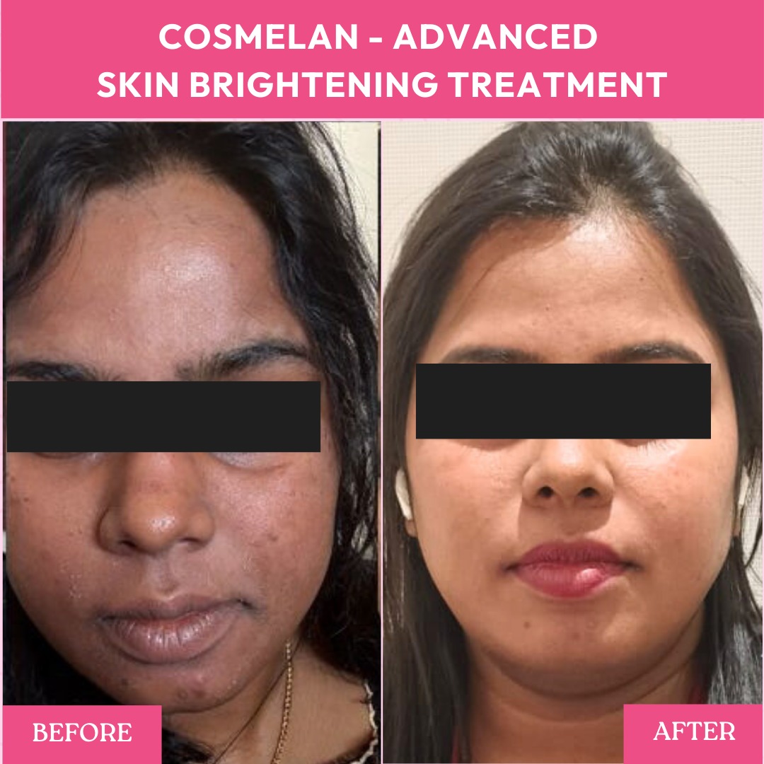 Laser Skin Brightening