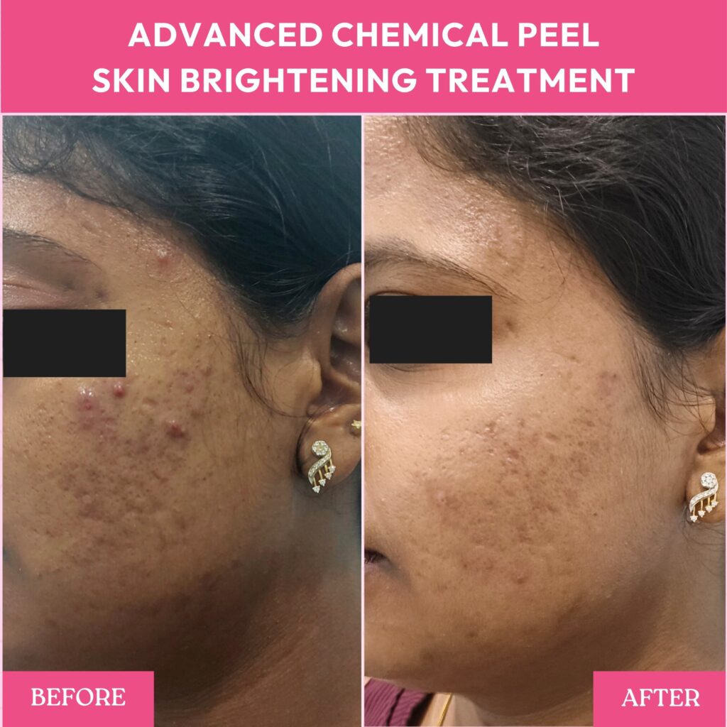 Benefits of chemical peel before and after results