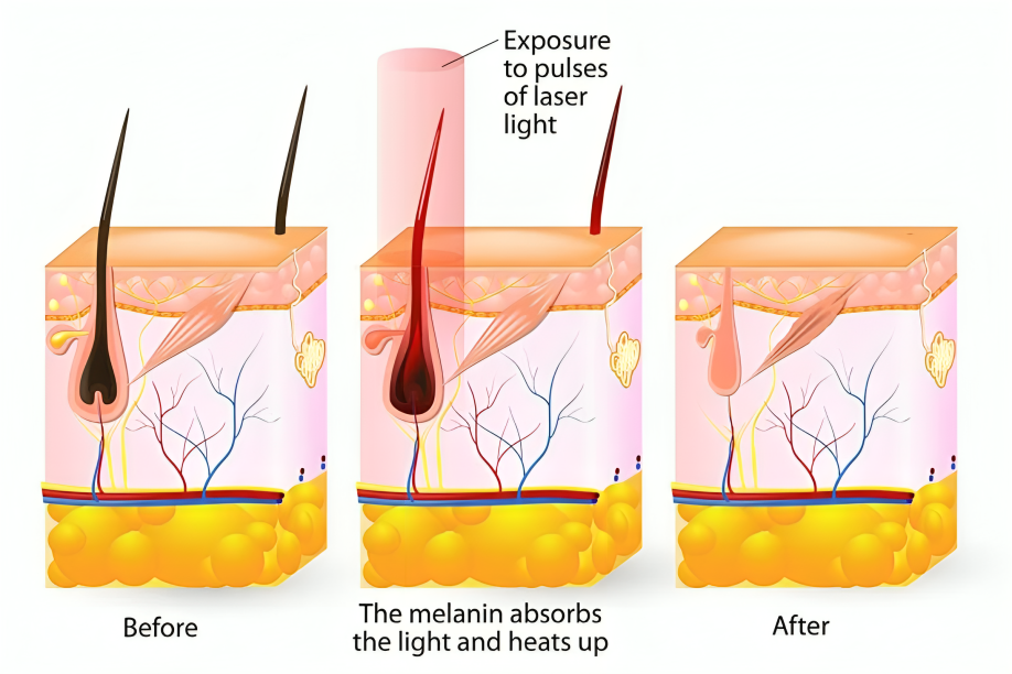 laser hair removal in chennai