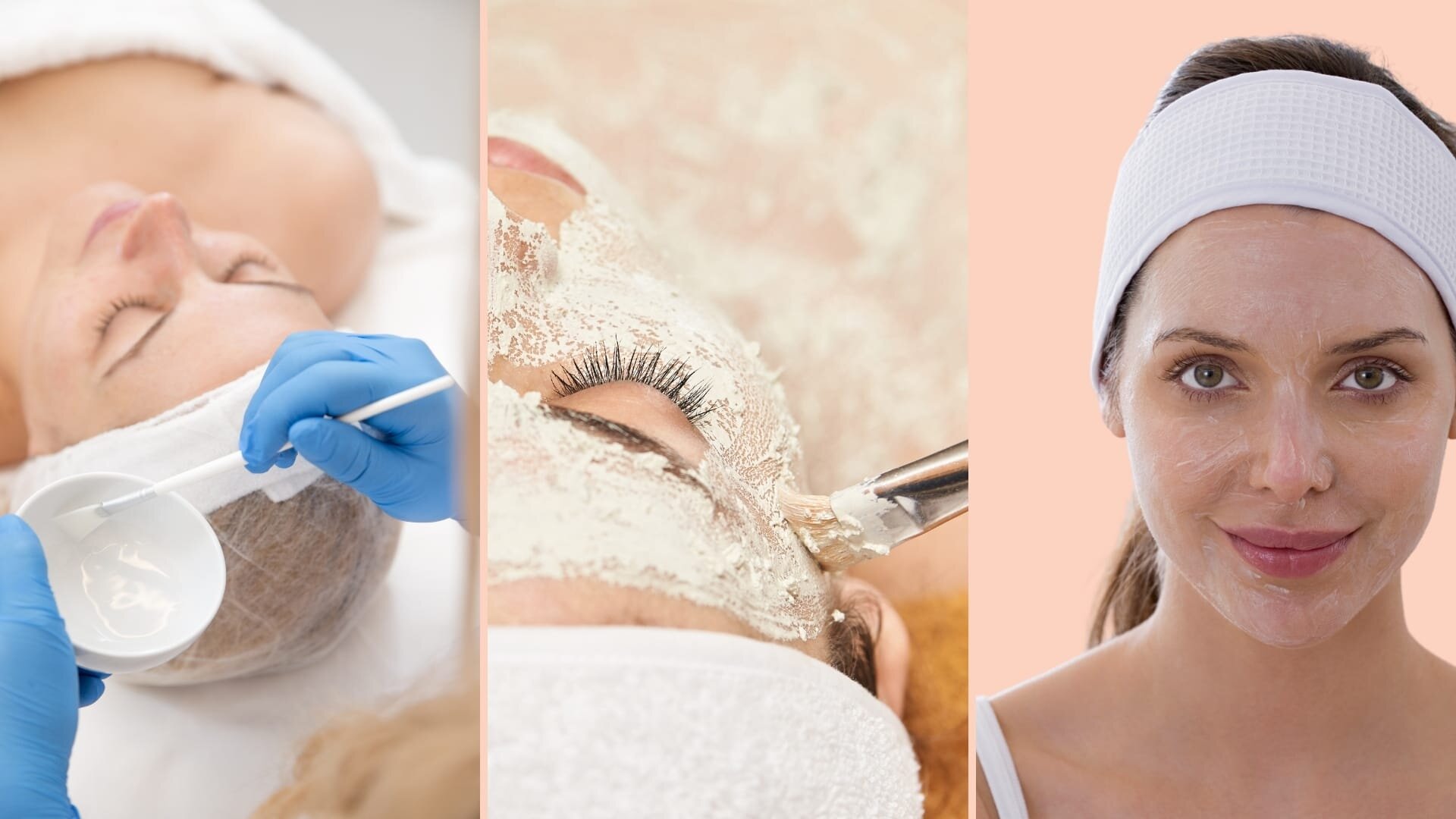 chemical peeling for pigmentation