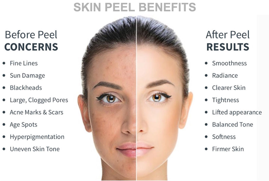 chemical peeling for pigmentation