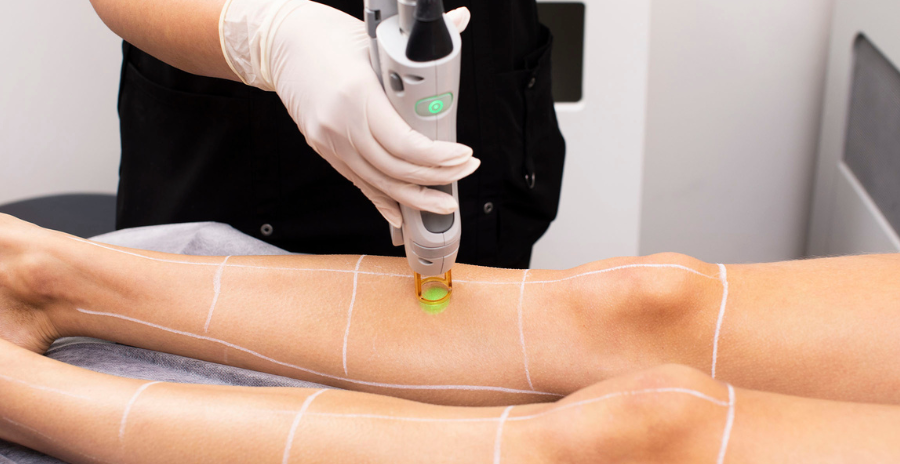 laser treatment for hair removal