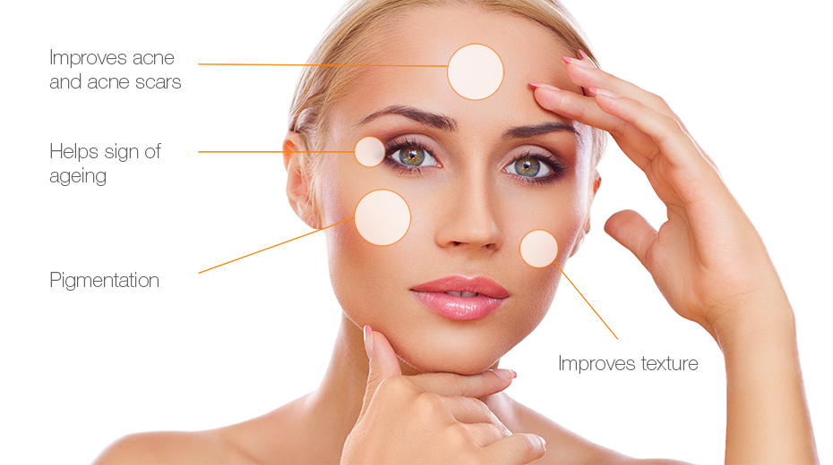 chemical peeling treatment 