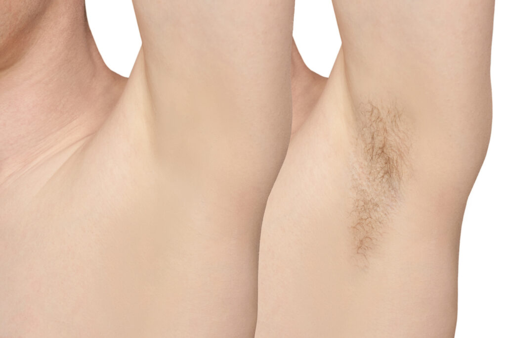 Laser hair removal in Chennai Nungambakkam