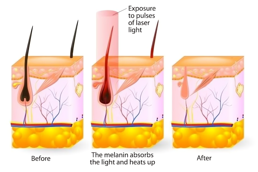 how laser hair removal works procedure
