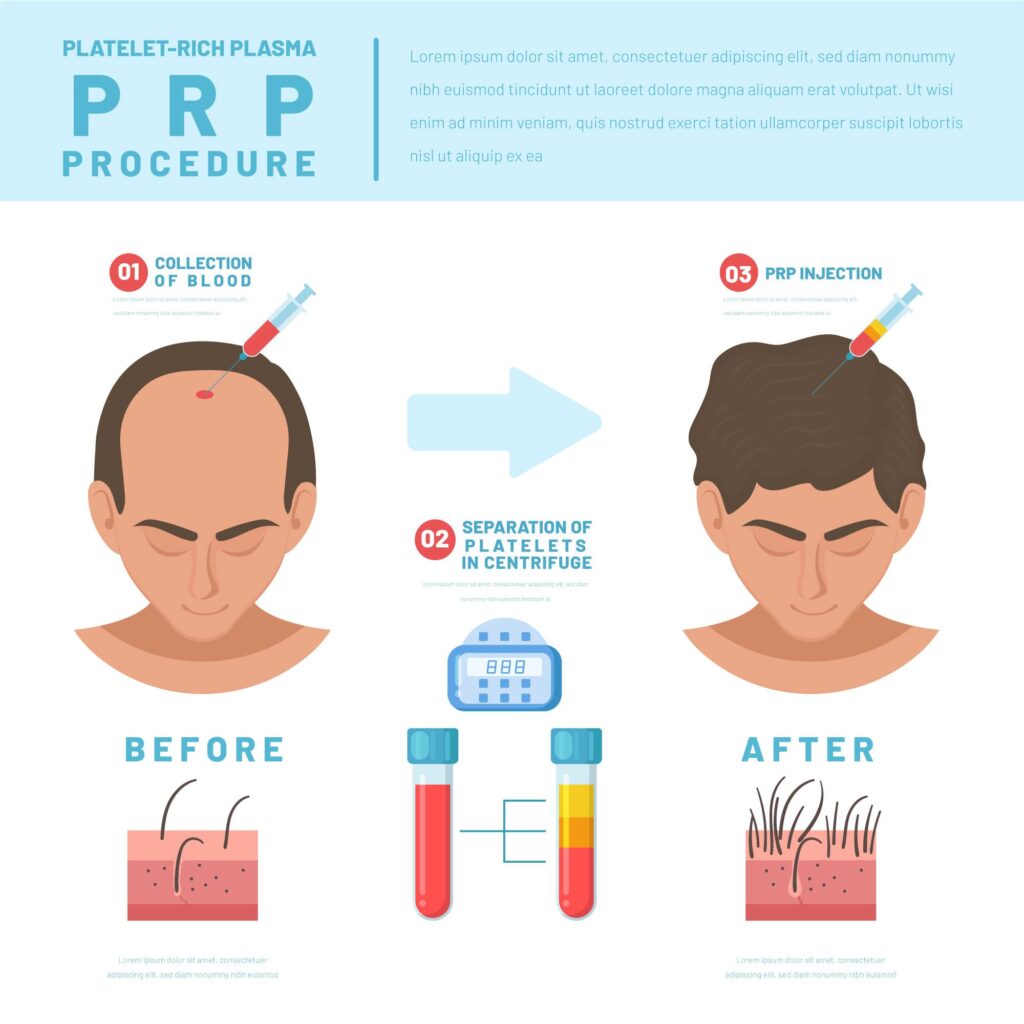 PRP hair treatment in Chennai procedure