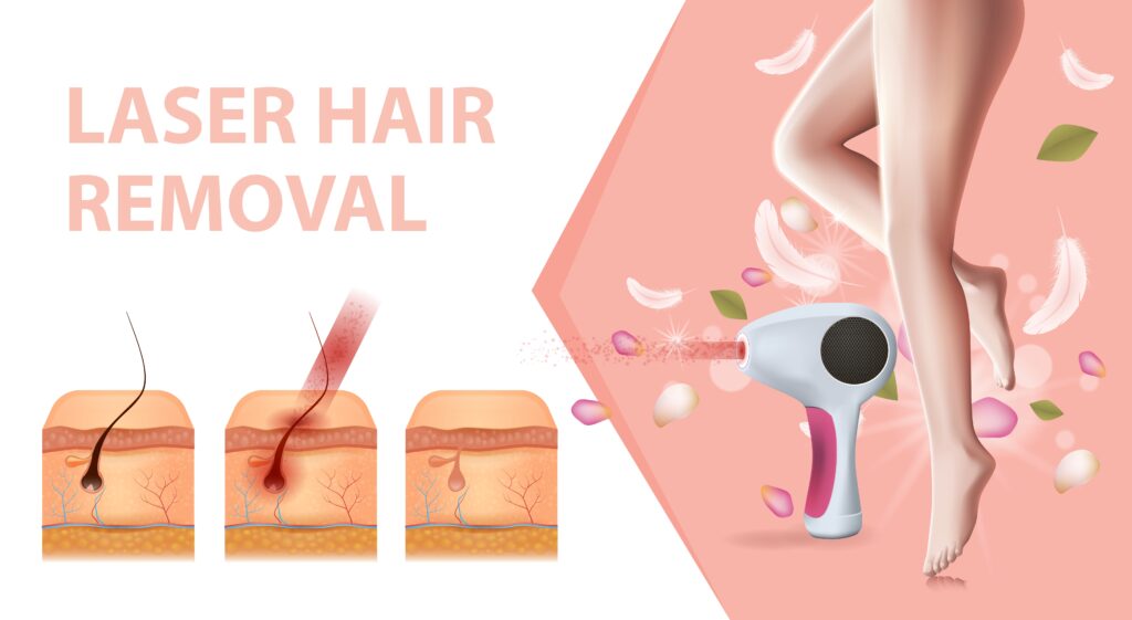 Laser hair removal in Chennai