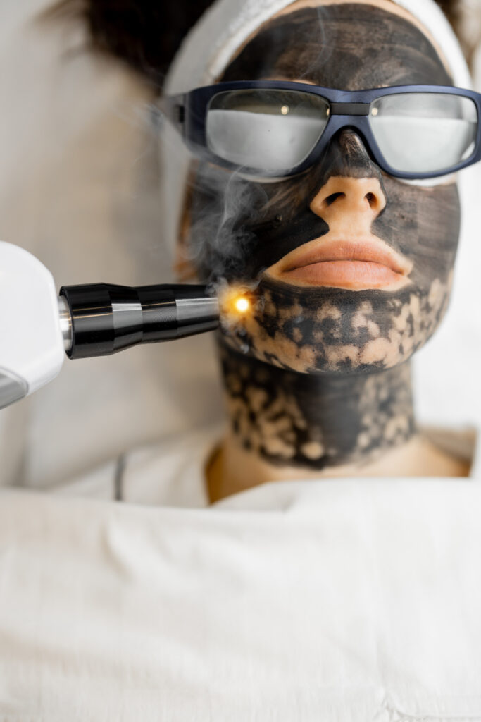 carbon laser in Chennai at Venus skin clinic