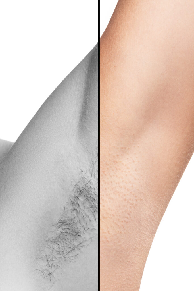 results of under arm laser hair removal before and after