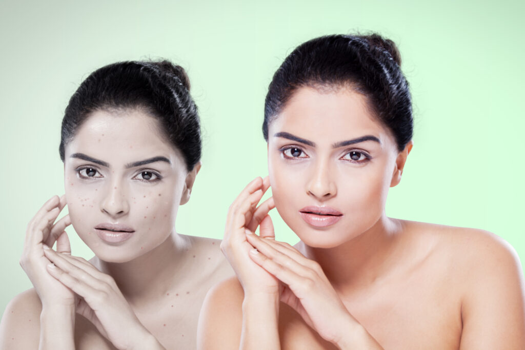 Skin whitening Treatment in Chennai