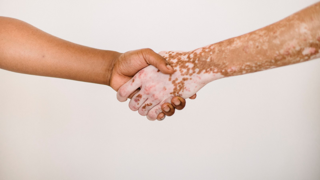 Vitiligo treatment
