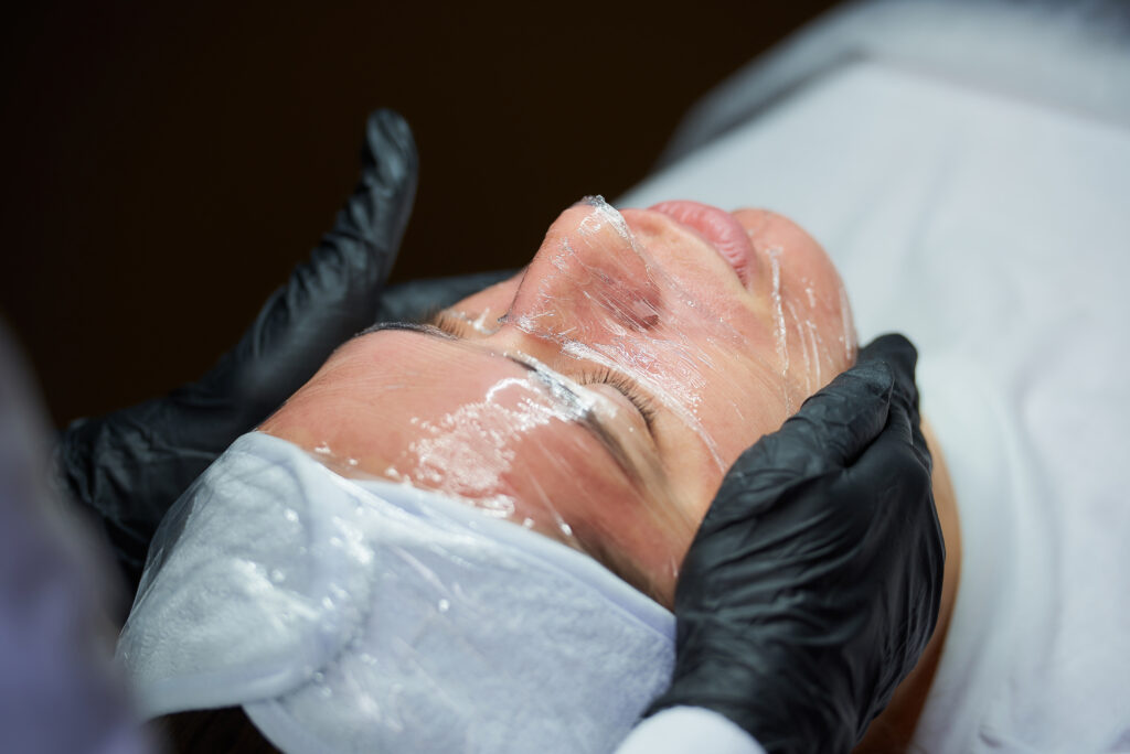 chemical peeling process