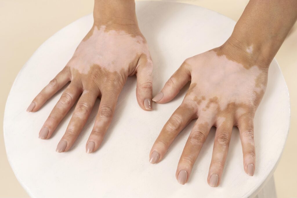 Vitiligo treatment in chennai