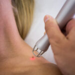 wart removal in Chennai