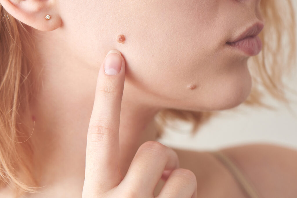 skin tag removal in chennai