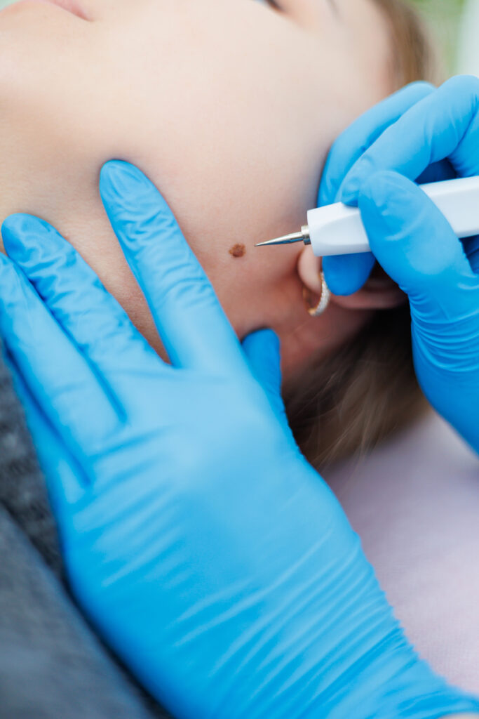 skin tag removal process