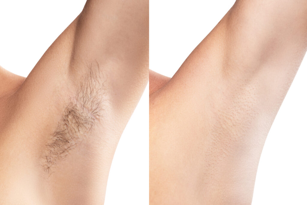 before and after of laser hair removal underarms