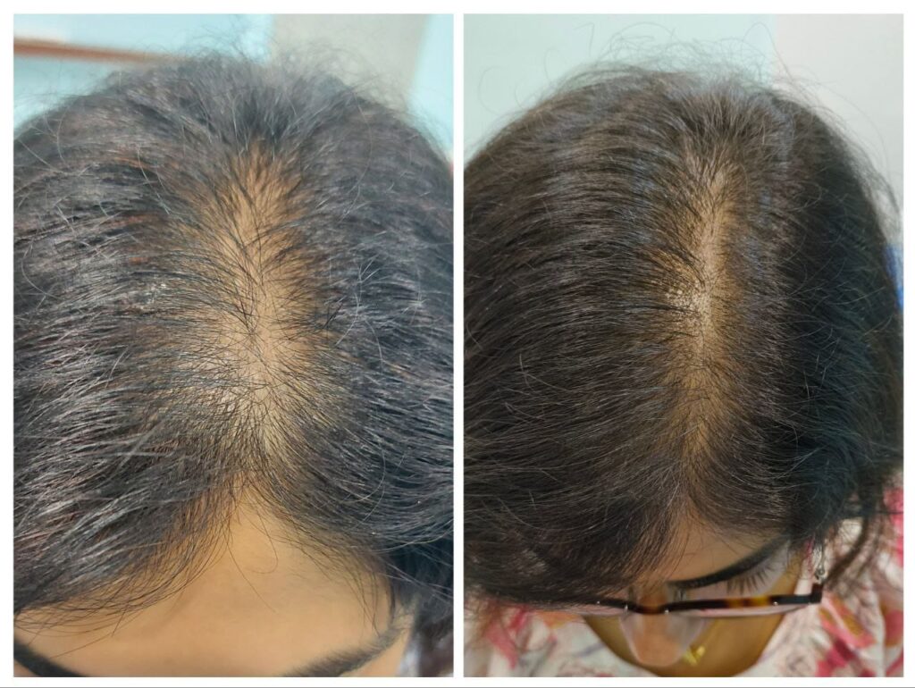 PRP FOR HAIR RESULTS