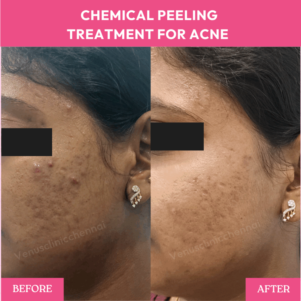 chemical peeling results 