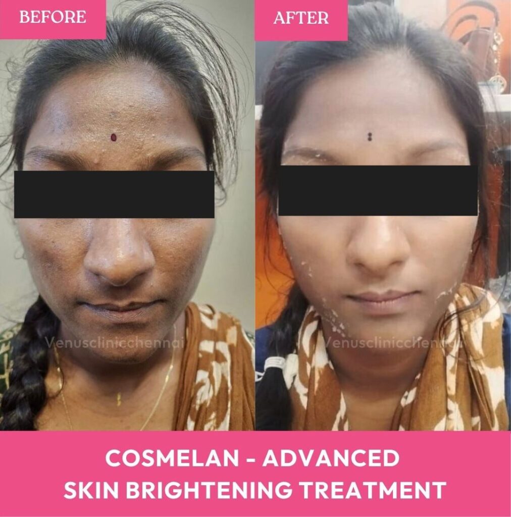 chemical peeling chennai results 