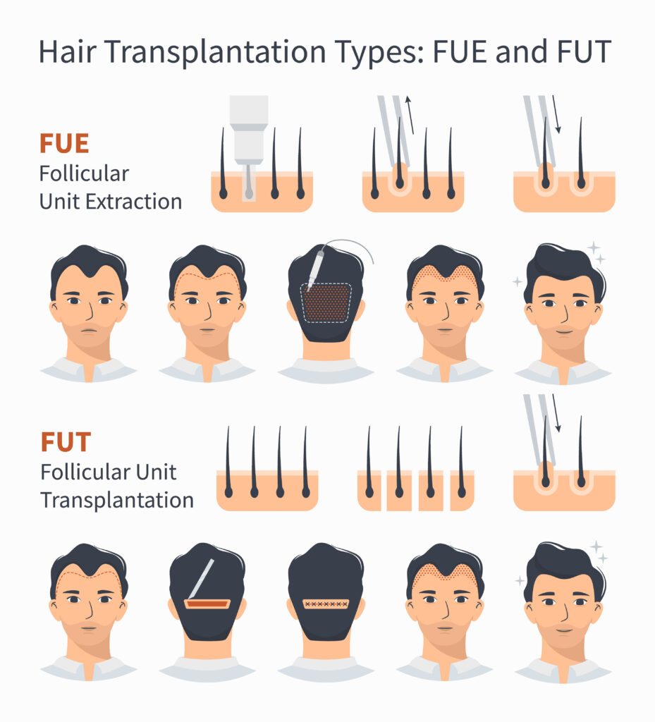 hair transplant clinic in chennai

