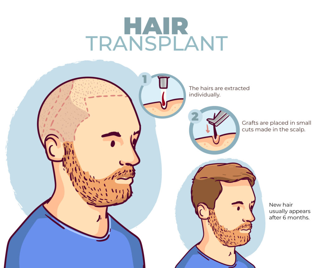 hair transplantation process