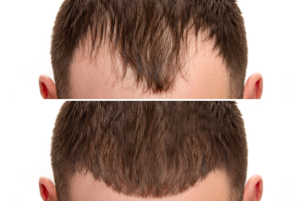 hair transplant results 