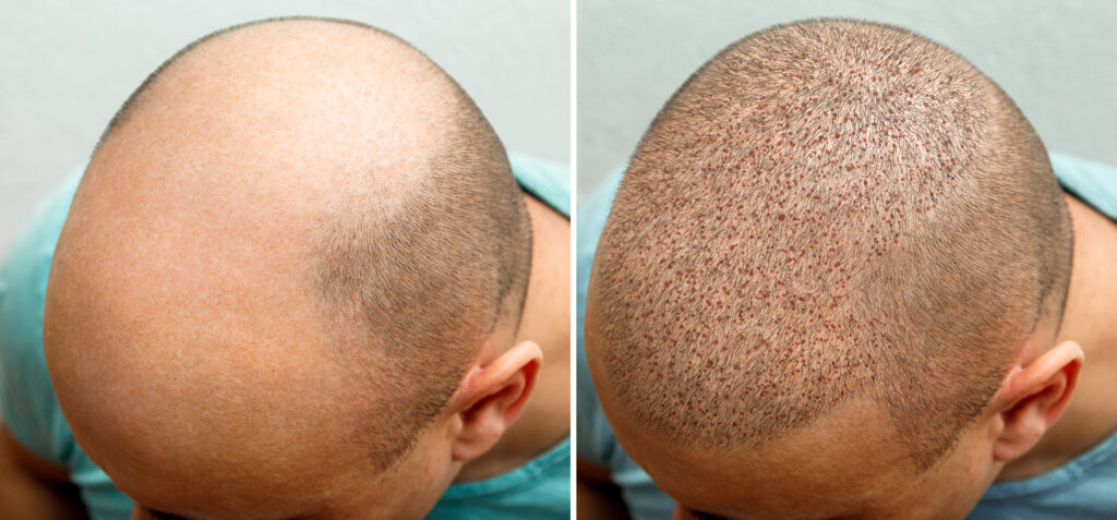 Hair Transplantation Clinic in Chennai
