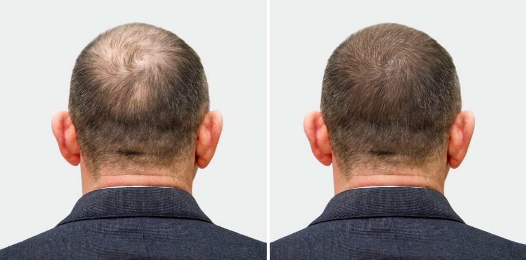 hair transplant chennai results