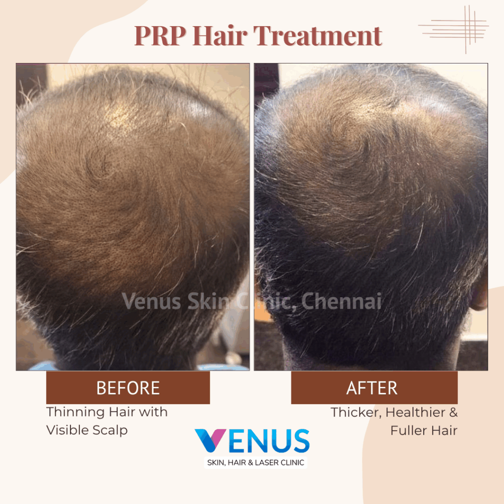 Hair Transplant Clinic Near Me