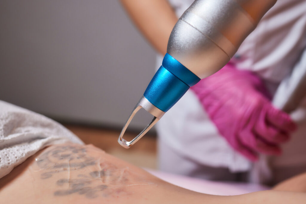 tattoo removal in chennai