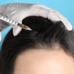prp hair treatment