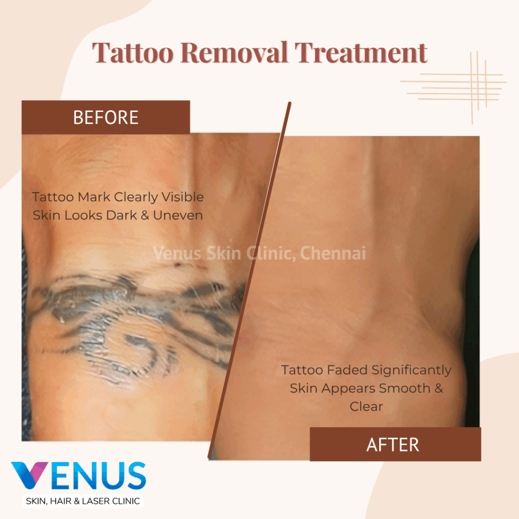 Tattoo Removal in Chennai