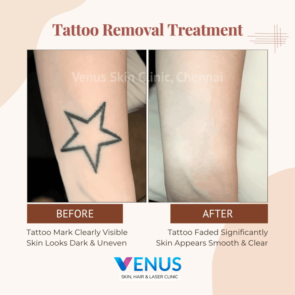 Tattoo Removal in Chennai