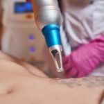 Tattoo Removal in Chennai