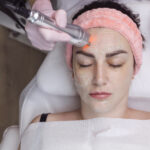CO2 Laser Treatment