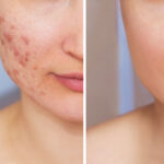 Best Scar Removal Treatment in Chennai