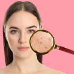 acne scar removal chennai