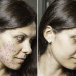 acne scar treatment cost chennai