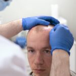 GFC Hair Treatment Cost in Chennai