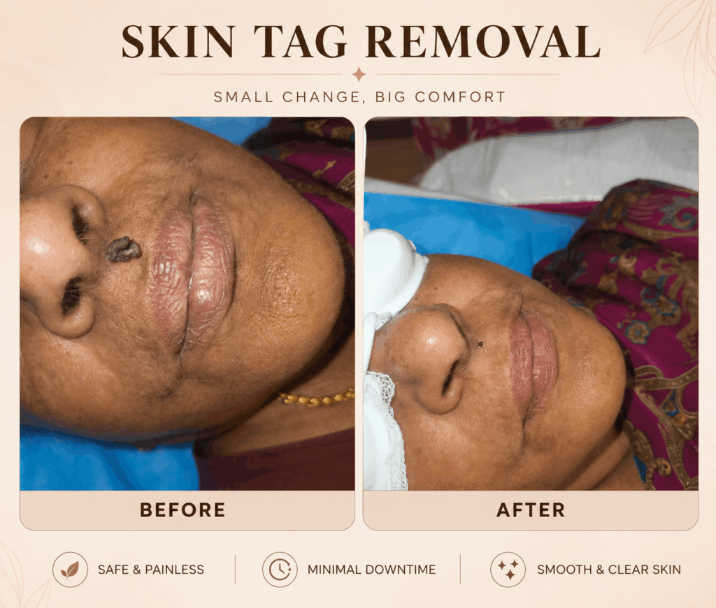 Skin tag removal chennai