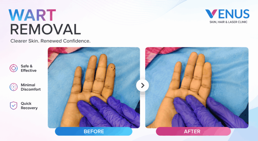 wart removal in chennai
