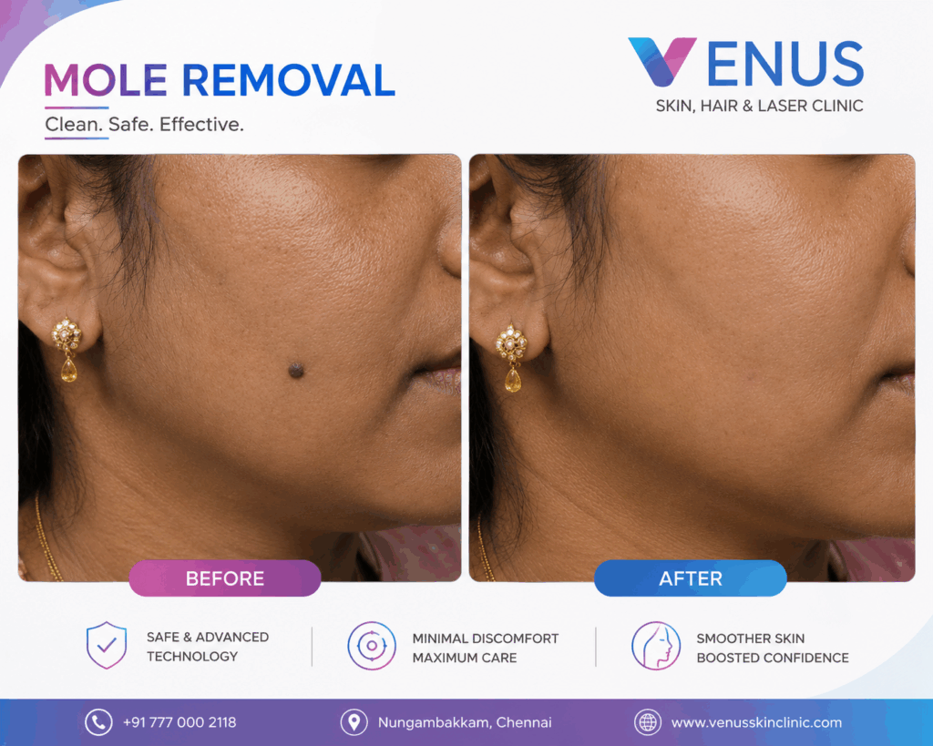 mole removal chennai