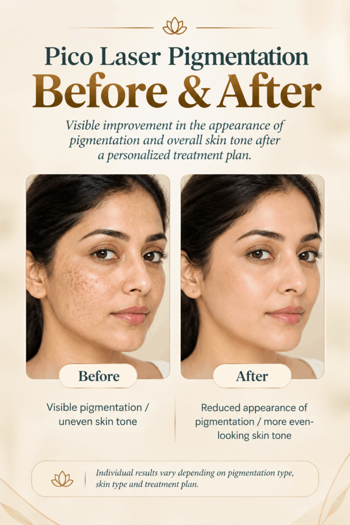 Pico laser for pigmentation before and after showing improvement in facial pigmentation and uneven skin tone