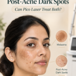 Melasma and post-acne dark spots on Indian skin for Pico Laser pigmentation treatment