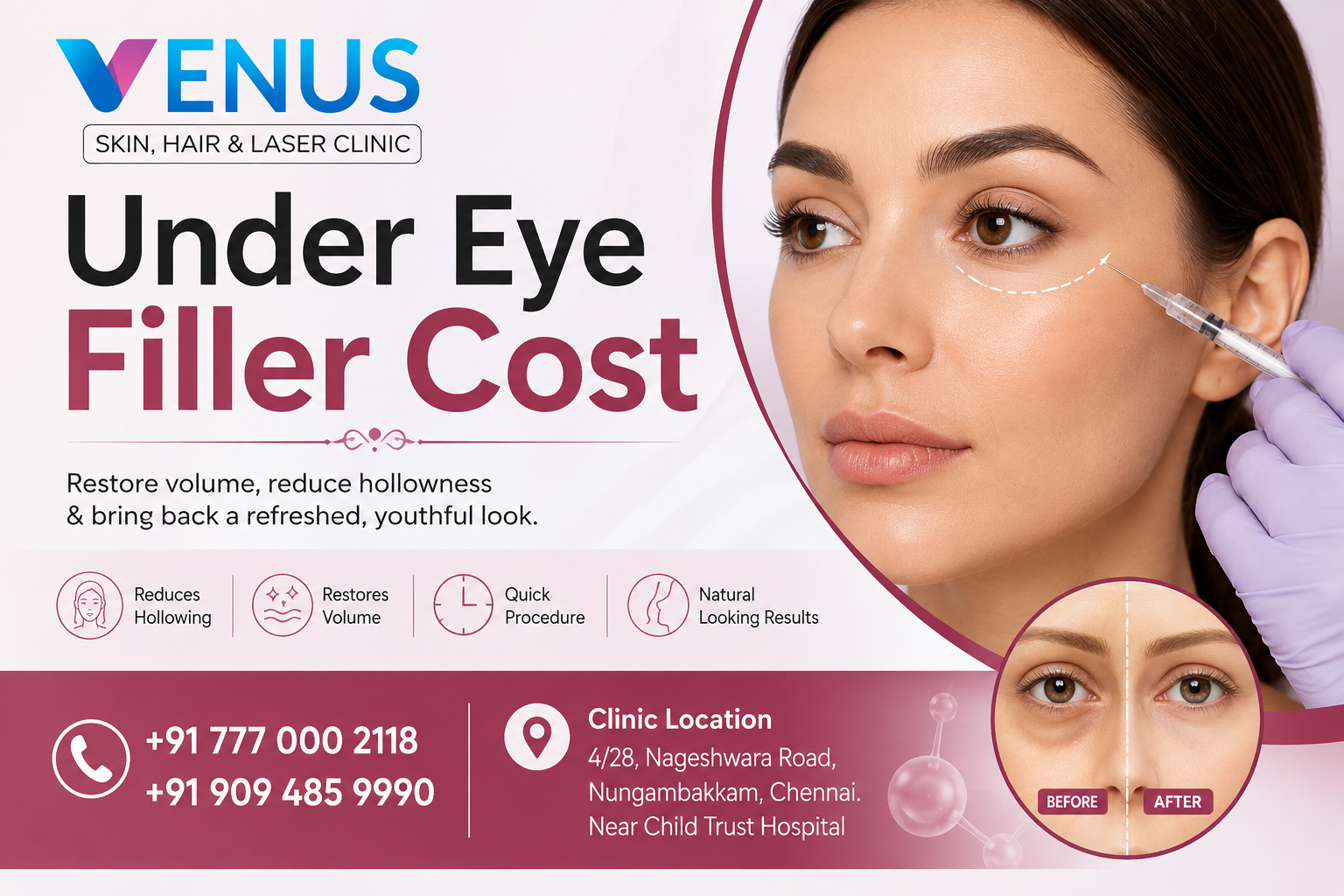 Treatment for Sunken Eyes